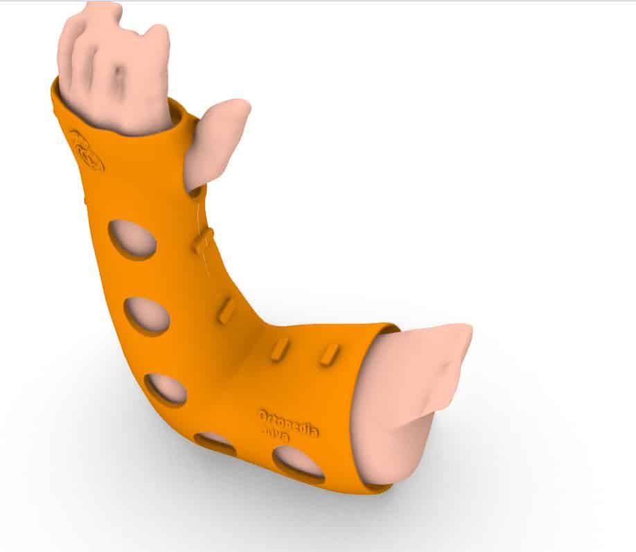 Ortesis brazo 3D